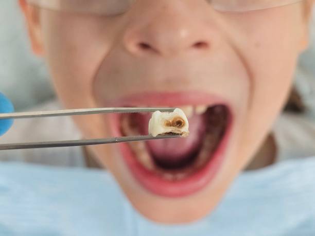 Best Emergency Broken Tooth Repair in Central City, IA